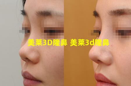 美莱3D隆鼻 美莱3d隆鼻